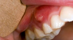 Áp xe răng là bệnh lý răng miệng thường gặp phổ biến hiện nay, gây ra đau đớn cho người bệnh