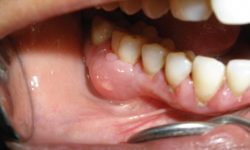 Áp xe răng khôn là bệnh gì? Có nguy hiểm không?