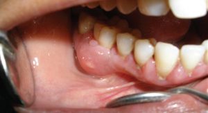 Áp xe răng khôn là bệnh gì? Có nguy hiểm không?