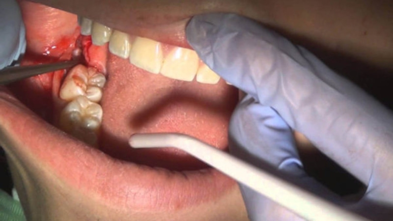 Trong trường hợp nặng người bệnh cần phải nhổ bỏ răng