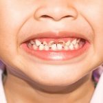 Bé bị sún răng phải làm sao: Nguyên nhân và cách điều trị hiệu quả