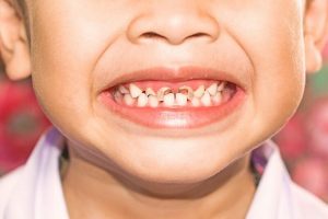 Bé bị sún răng phải làm sao: Nguyên nhân và cách điều trị hiệu quả