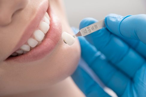 Bọc răng sứ thẩm mỹ giúp cải thiện hàm răng tự nhiên được đẹp hơn