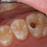 Cách chữa viêm tủy răng và những điều cần biết