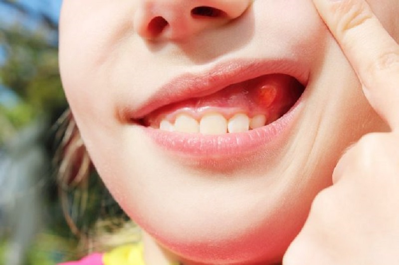 Áp xe răng là một dạng nhiễm trùng răng miệng nguy hiểm