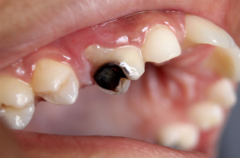 Sâu răng là một trong số những nguyên nhân hàng đầu gây bệnh