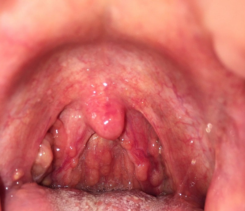 Viêm họng cấp, viêm họng hạt là tác nhân chính gây hôi miệng trong cổ họng.