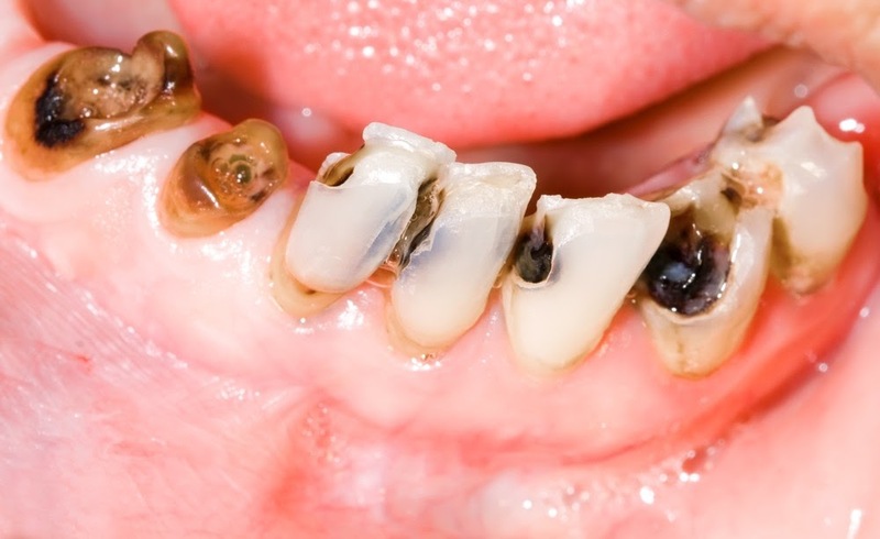 Sâu răng là tình trạng rất phổ biến hiện nay