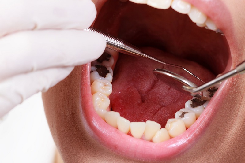 Với trường hợp nghiêm trọng, biến chứng nặng nề bắt buộc phải nhổ răng