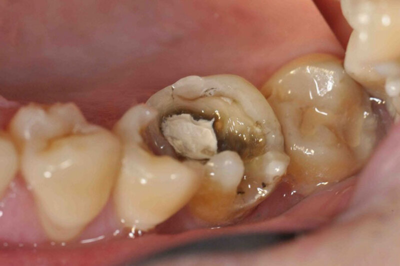 Tình trạng này có thể làm ảnh hưởng đến sức khỏe răng miệng