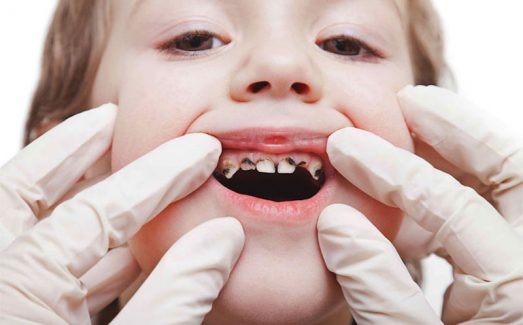 Sún răng là bệnh lý dễ gặp ở trẻ, khiến cho cấu trúc răng bị phá hủy nặng nề