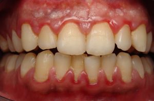 Nên dùng thuốc chữa viêm lợi loại nào là phù hợp?