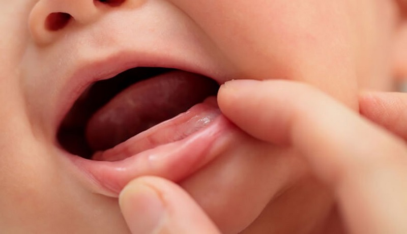 Chậm mọc răng có thể gây nên nhiều biến chứng sau này