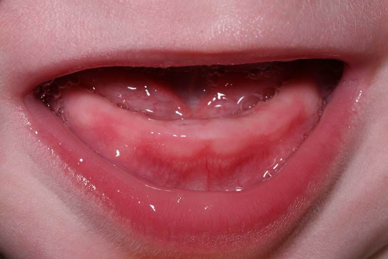 Nhiều bé bị chậm mọc răng là bẩm sinh