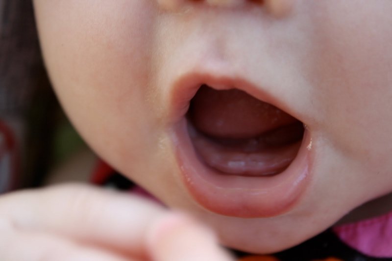 Trẻ chậm mọc răng không phải tình trạng hiếm gặp
