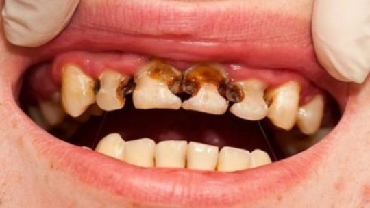 Làm thế nào để điều trị sâu răng hiệu quả nhất?