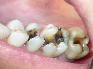 Trị sâu răng cho bé bằng phương pháp nào để đảm bảo an toàn