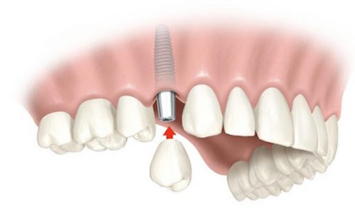 Trồng răng sứ là giải pháp mang đến nhiều lợi ích đối với mọi người