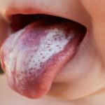 Tưa miệng là bệnh lý rất dễ gặp hiện nay, đặc biệt là ở đối tượng trẻ nhỏ