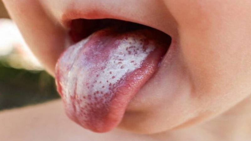 Tưa miệng là bệnh lý rất dễ gặp hiện nay, đặc biệt là ở đối tượng trẻ nhỏ