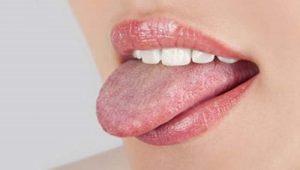 Tưa miệng khi mang thai: Những điều mẹ bầu cần biết
