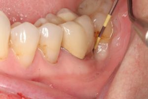 Viêm chân răng là bệnh lý răng miệng xảy ra rất phổ biến hiện nay
