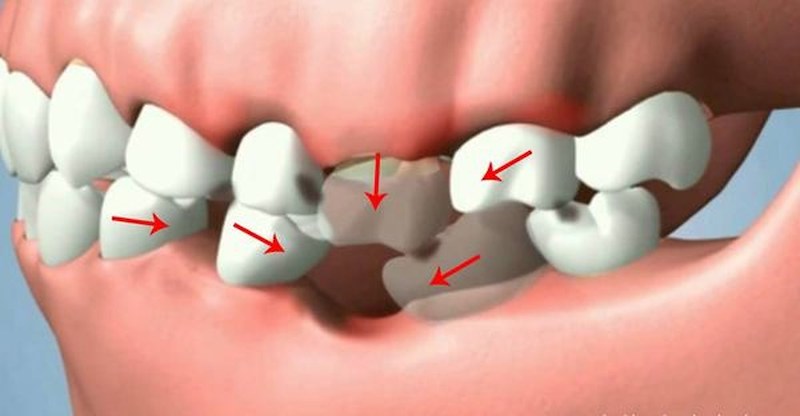 Biến chứng của bệnh có thể gây ra hiện tượng mất răng hoàn toàn