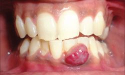 Viêm chân răng có mủ là gì? Nguyên nhân và cách điều trị