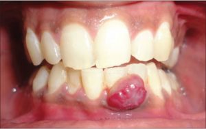 Viêm chân răng có mủ là gì? Nguyên nhân và cách điều trị