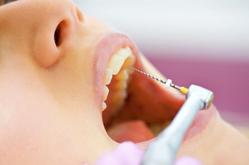 Viêm tủy răng cần điều trị bằng Tây y hiện đại