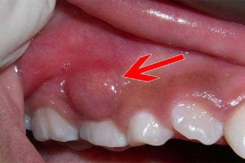 Áp xe nướu răng: Nguyên nhân, dấu hiệu và hướng điều trị