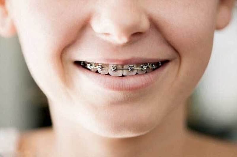 Răng hỗn hợp là giai đoạn niềng răng tốt nhất cho trẻ