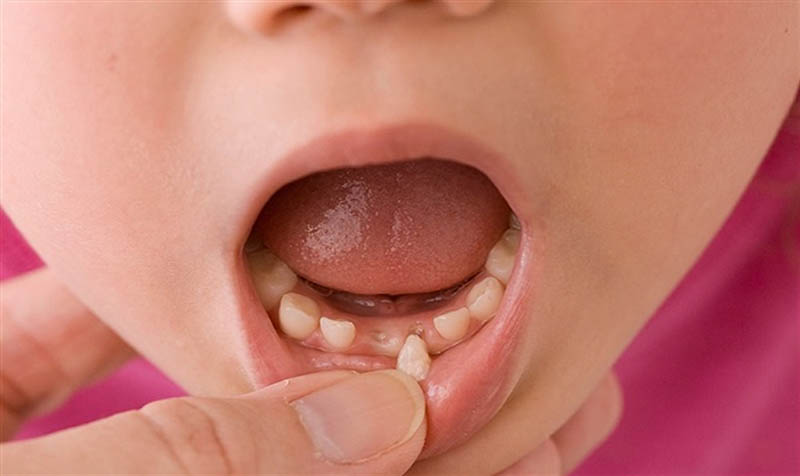 Không cho tay vào phần răng sữa mới nhổ để tránh làm viêm nhiễm nướu trẻ