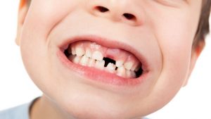 Nhổ răng sữa bao lâu mọc lại