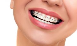Chi phí niềng răng 1 hàm là bao nhiêu? Phụ thuộc những yếu tố nào?
