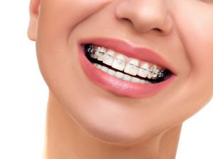Chi phí niềng răng 1 hàm là bao nhiêu? Phụ thuộc những yếu tố nào?