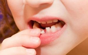 Khi nào nhổ răng sữa cho bé