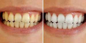 Cạo vôi răng giúp bạn loại bỏ những mảng bám trên răng