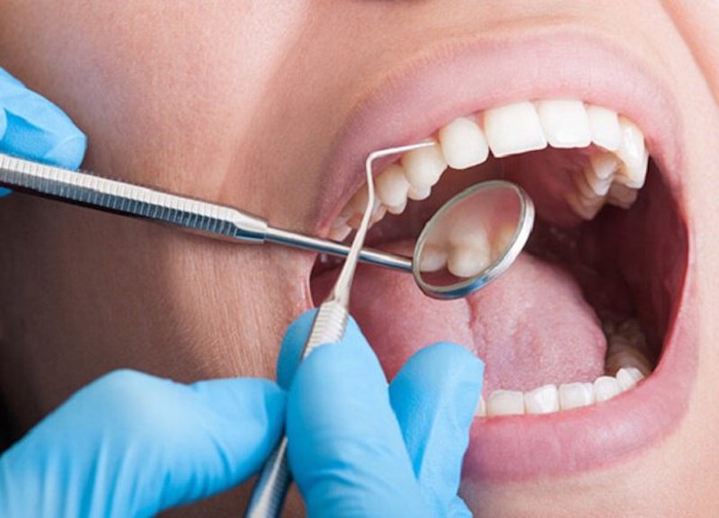 Lấy cao răng sẽ mang đến nhiều lợi ích nếu bạn không lạm dụng