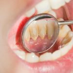 Nha sĩ cần tuân thủ đúng theo các nguyên tắc để đảm bảo lấy vôi răng an toàn