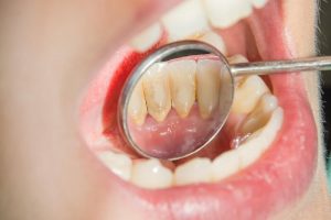 Nha sĩ cần tuân thủ đúng theo các nguyên tắc để đảm bảo lấy vôi răng an toàn