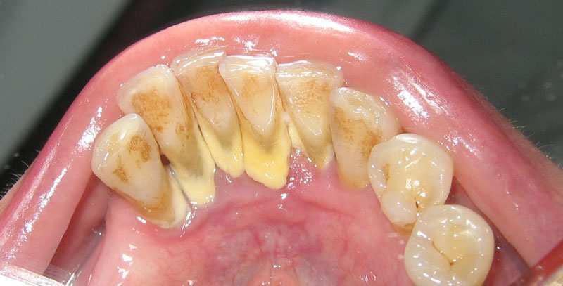 Cao răng hay còn gọi là vôi răng thường tích tụ ở sát chân răng