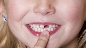 nhổ răng sữa cho trẻ bao nhiêu tiền