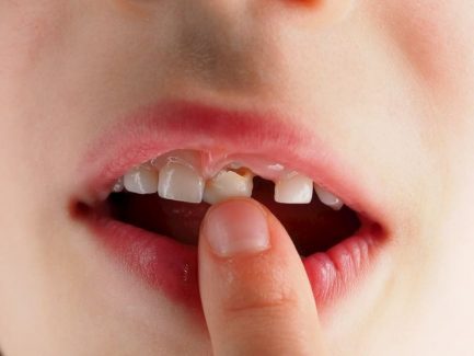 Chân răng sữa không được nhổ hết tùy từng trường hợp mà có mức độ nguy hiểm khác nhau