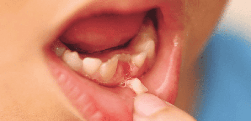 Nhổ răng sữa mọc lệch chính là phương pháp phổ biến giúp khắc phục tình trạng răng mọc lẫy