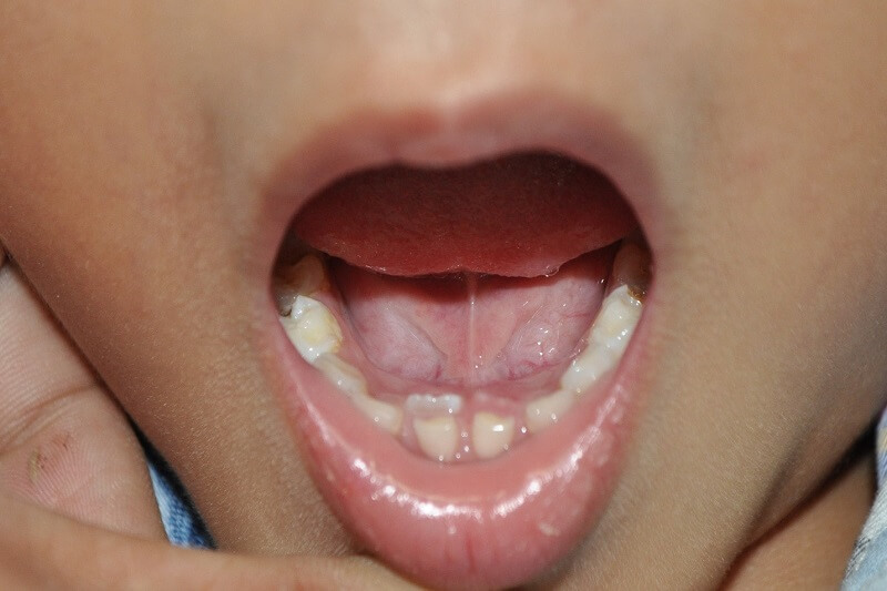 Răng trẻ mọc lẫy có thể khởi phát do nhiều nguyên nhân khác nhau