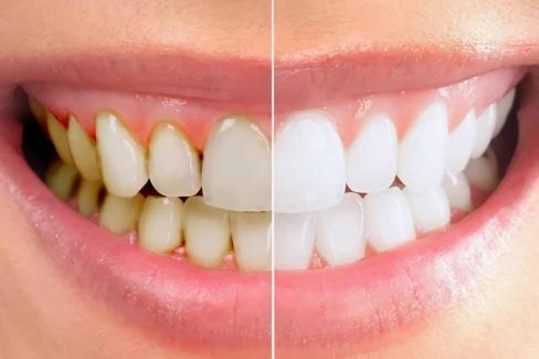 Cao răng là sự tích tụ và cứng lại của mảng bám, khoáng chất từ nước bọt