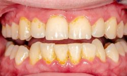 Lấy cao răng có được bảo hiểm y tế không