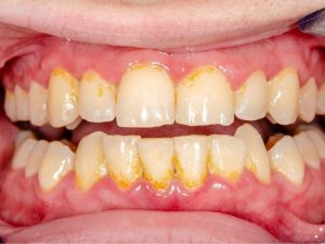 Lấy cao răng có được bảo hiểm y tế không
