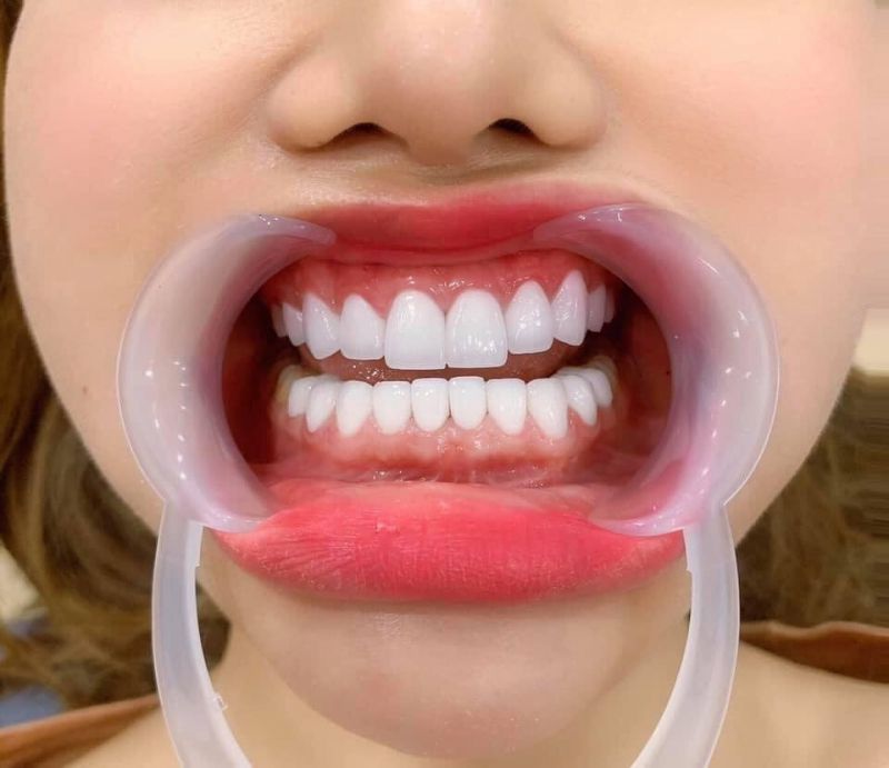 Bác sĩ sẽ gắn cố định răng sứ bằng chất liệu chuyên dụng dùng trong nha khoaBác sĩ sẽ gắn cố định răng sứ bằng chất liệu chuyên dụng dùng trong nha khoa